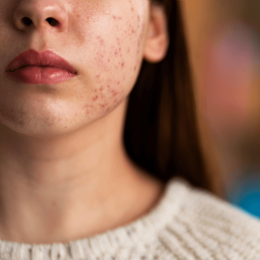 Nahaufnahme der unteren Gesichtshälfte einer Person mit sichtbaren Hautunreinheiten, passend zum Thema Hautpflege und Behandlung.