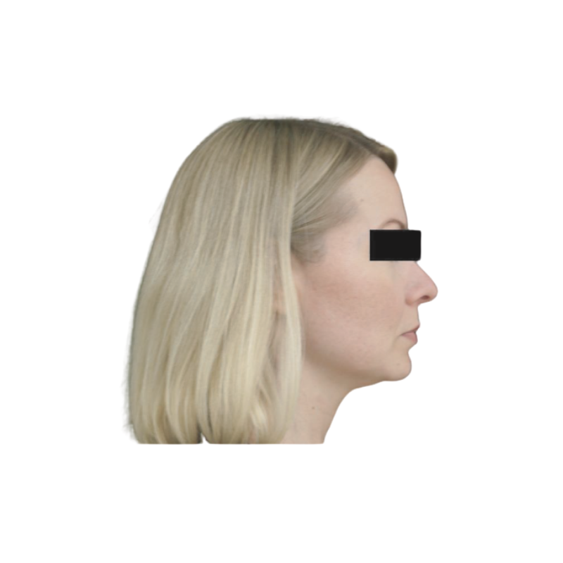 Seitenprofil einer Person mit anonymisierten Augenbereich, aufgenommen als Nachher-Bild nach der 12D Max-Lift-Behandlung zur Dokumentation der Konturstraffung im Kiefer- und Halsbereich.
