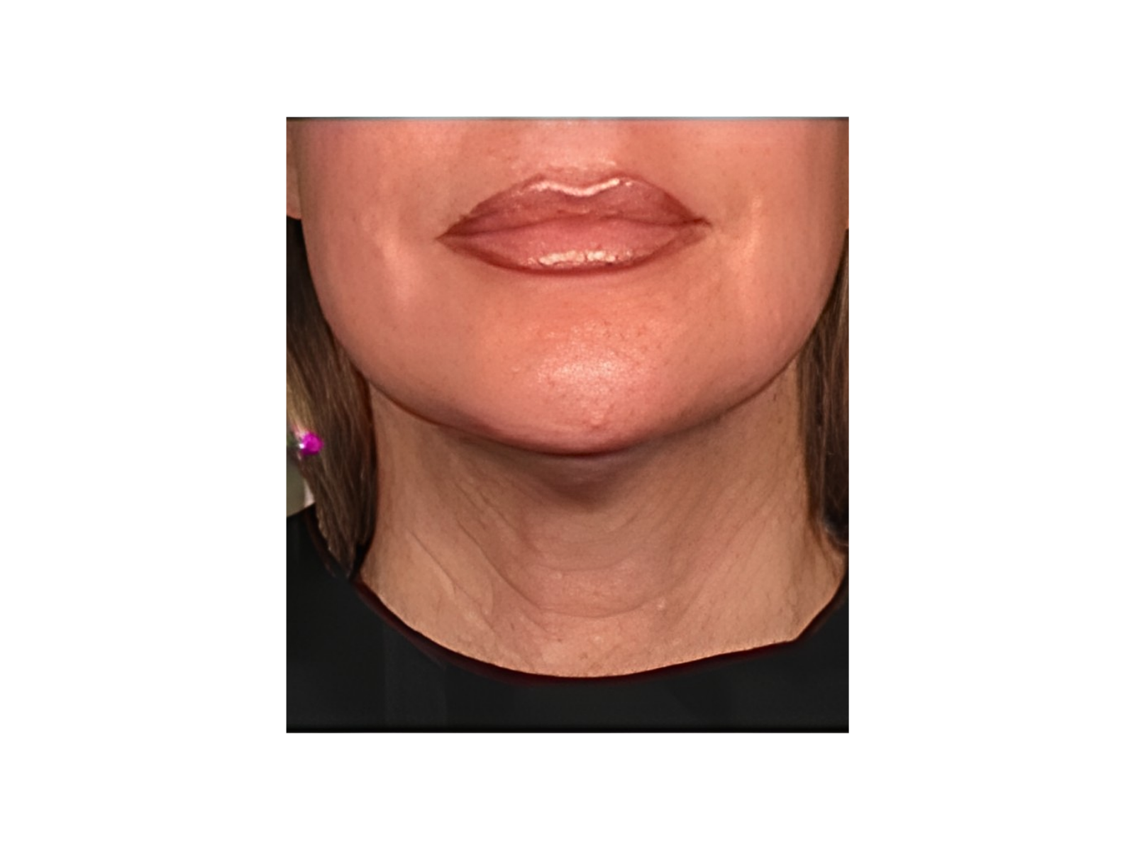 Nahaufnahme des unteren Gesichtsbereichs mit Kinn und Hals, aufgenommen als Nachher-Bild zur Dokumentation des Hautbilds nach erfolgreicher 12D Max-Lift-Behandlung.