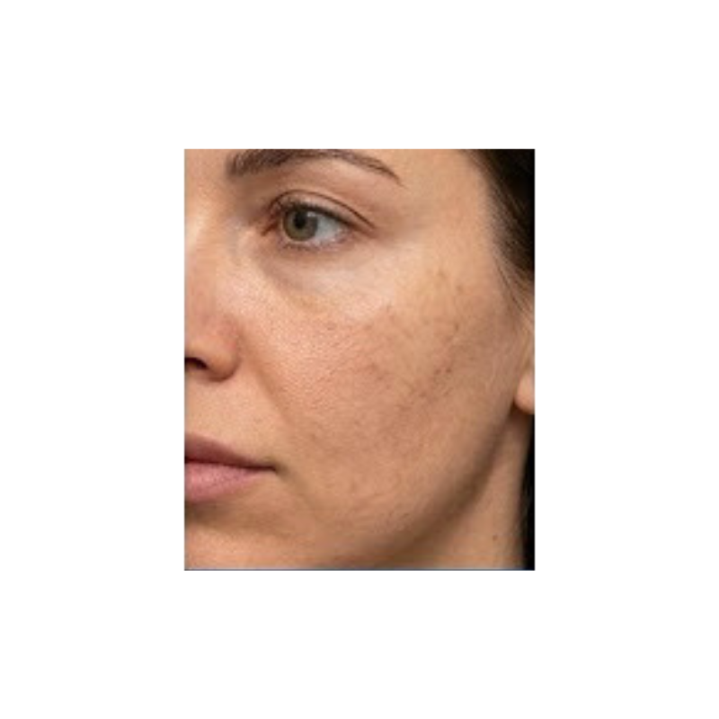 Nahaufnahme einer Gesichtshälfte, aufgenommen als Vorher-Bild vor der Ice Blue Hydro-Facial-Behandlung zur Dokumentation des Ausgangszustands der Haut bei Pigmentierungen und Unreinheiten.