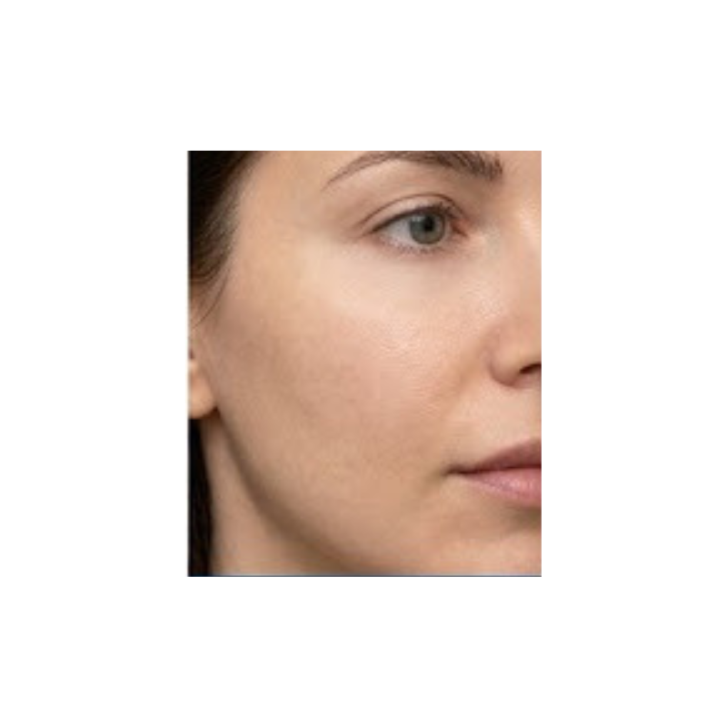 Nahaufnahme einer Gesichtshälfte, aufgenommen als Vorher-Bild vor der Ice Blue Hydro-Facial-Behandlung zur Dokumentation des Ausgangszustands der Haut bei Pigmentierungen und Unreinheiten.