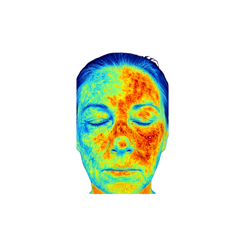 KI-gestützte Hautanalyse mit DemiDora Oracle Vision Pro: Hochauflösende Darstellung von Hautbeschaffenheit, Fältchen und Pigmentierungen zur präzisen Diagnose.