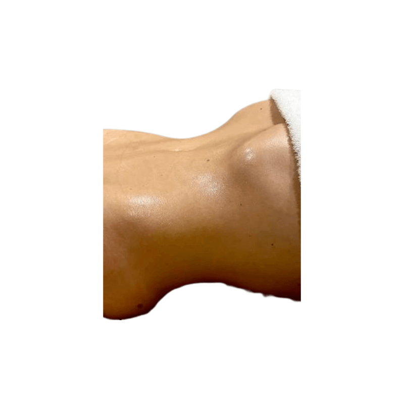 DemiDora AuraSculpt X10 V Nach der Behandlung Bauchstraffung und Körperformung