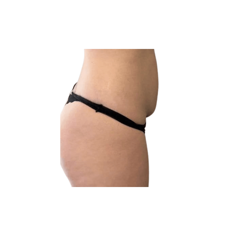 DemiDora AuraSculpt X10 Nach der Behandlung Bauchstraffung und Körperformung
