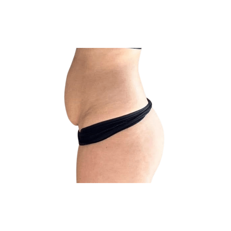 DemiDora AuraSculpt X10 Vor der Behandlung Bauchstraffung und Körperformung