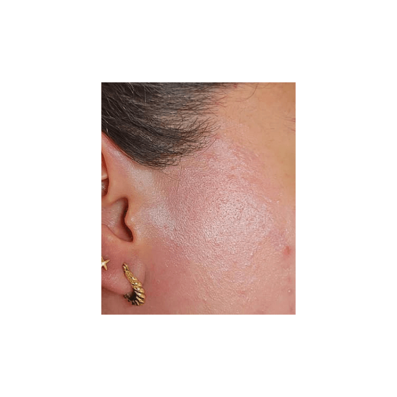 Vorher-Nachher-Vergleich: Laser-Haarentfernung am Unterkiefer und Hals einer Frau mit dem DemiDora Soprano LuminaCore 360 Diodenlaser. Zeigt die deutliche Haarreduktion, glatte Haut und verbesserte Hautstruktur nach der professionellen Tri-Wave Behandlung.