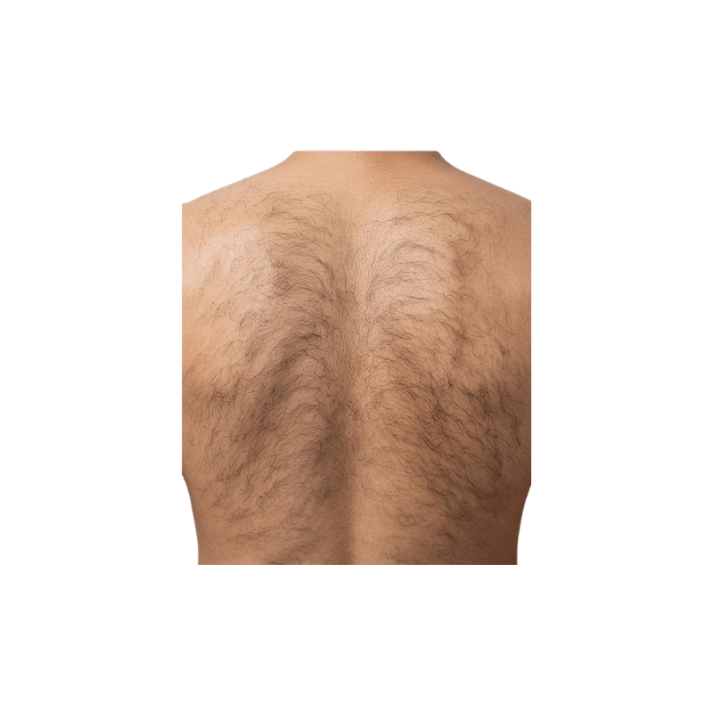 Vorher-Zustand: Rückenpartie mit ausgeprägtem Haarwuchs vor der Laser-Haarentfernung. Das Bild zeigt die Ausgangslage für die professionelle Behandlung mit dem DemiDora Soprano LuminaCore 360 Diodenlaser zur dauerhaften Haarreduktion.