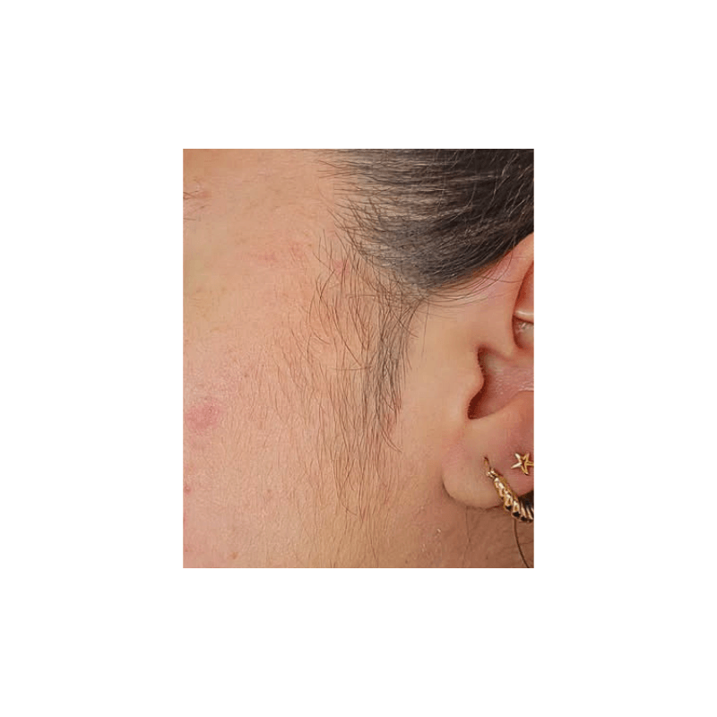 Vorher-Zustand: Detaillierte Aufnahme einer Gesichtspartie vor der Laser-Behandlung, zeigt sichtbaren Haarwuchs im Bereich vor dem Ohr, der mit dem DemiDora Soprano LuminaCore 360 Diodenlaser effektiv und dauerhaft entfernt wird.