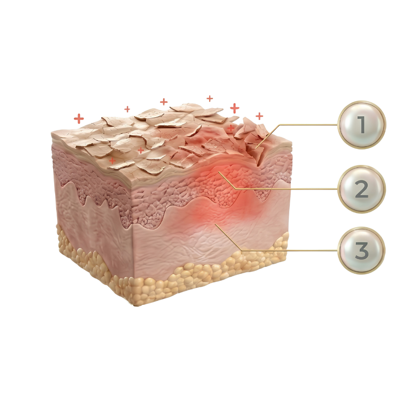 Medizinische Illustration eines Hautquerschnitts (Epidermis und Dermis), die Entzündungszeichen und eine trockene, schuppige Hautoberfläche bei Rosacea darstellt, ergänzt durch drei nummerierte Markierungspunkte zur weiteren Erläuterung.